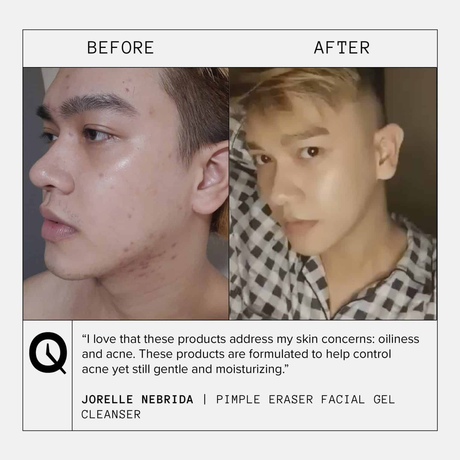 Pimple Eraser Facial Gel Cleanser 75ML QUICKFX